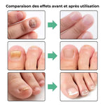 Charger l'image dans la galerie, OnglePur™ - Stylo Anti-Mycose Express Ta solution discrète pour des ongles sains en 21 jours