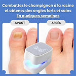 Charger l'image dans la galerie, Laser Ongles Pro™- traitement définitif des mycoses
